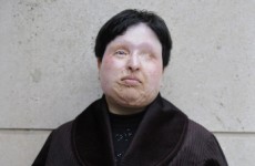 Iranian man due to be blinded over acid attack pardoned by victim